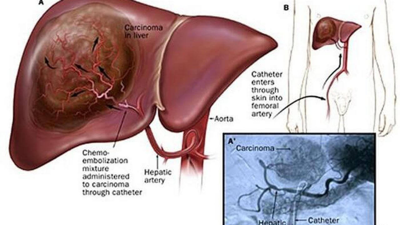 Benefits of Chemoembolization for Liver Cancer