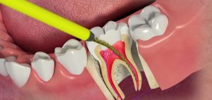 emergency root canal near me