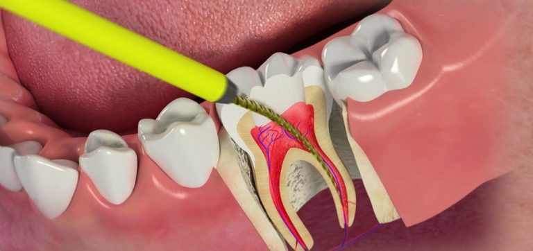Emergency Root Canal Near Me: Can They Be Done Same Day?