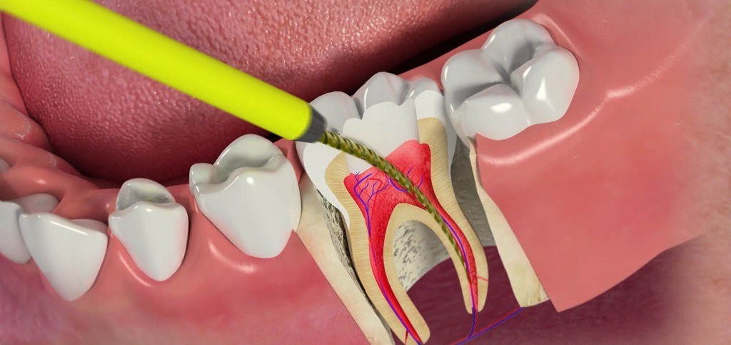 emergency root canal near me