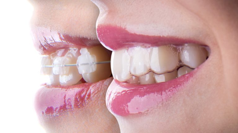The Top 5 Benefits Of Invisalign Over Braces