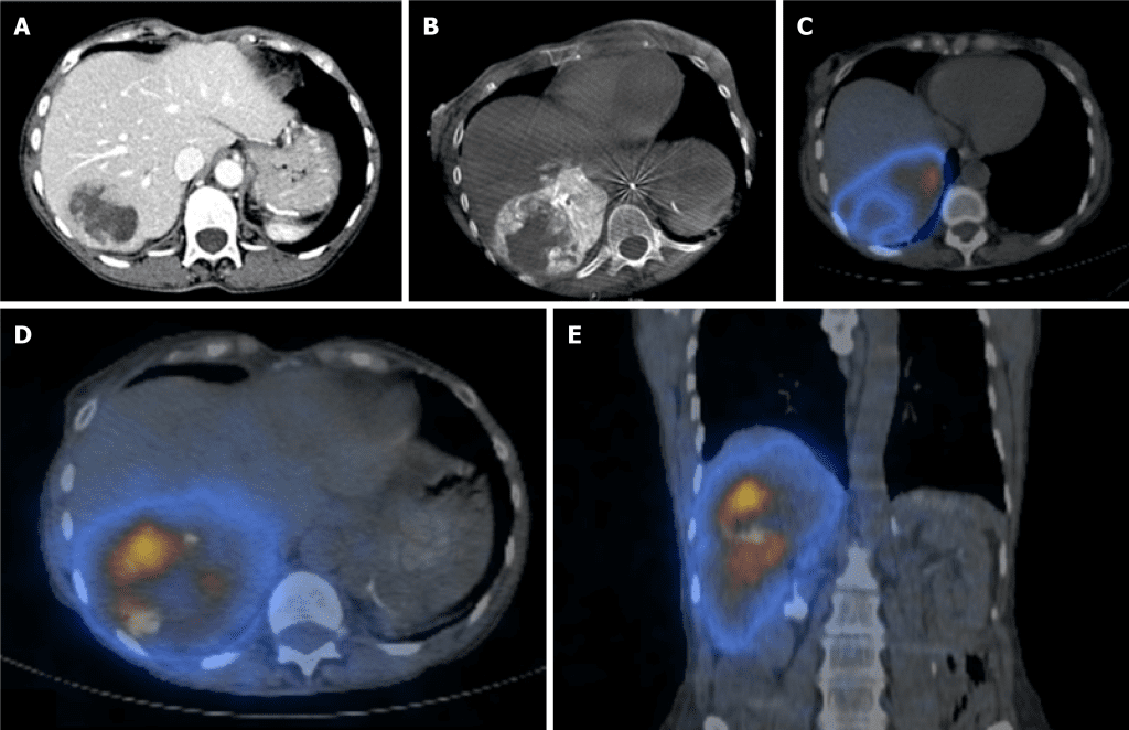 Radioembolization Y-91 is a treatment