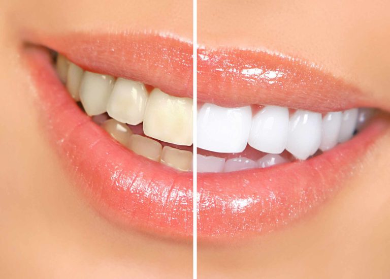 Teeth Cleaning Cost: How Much Does A Deep Teeth Cleaning Cost?