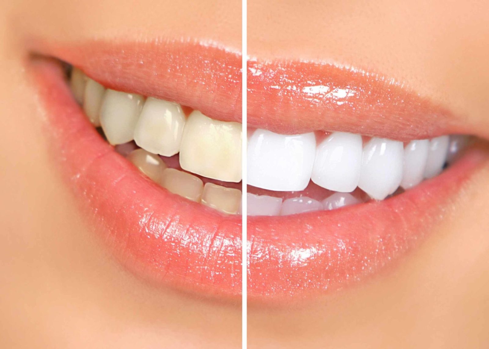 teeth bleaching scaled